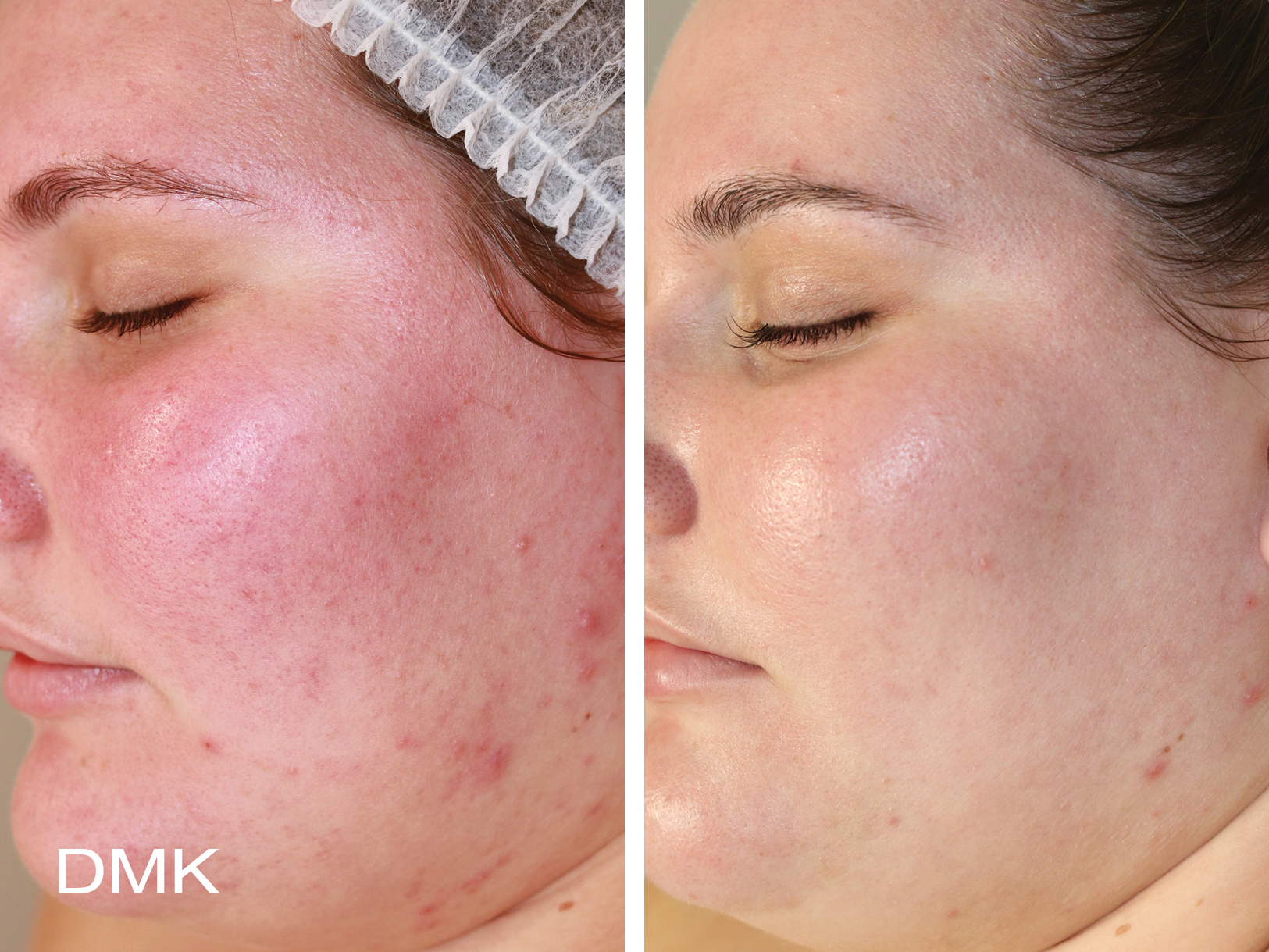 Reactive skin DMK Results DMKCustomer