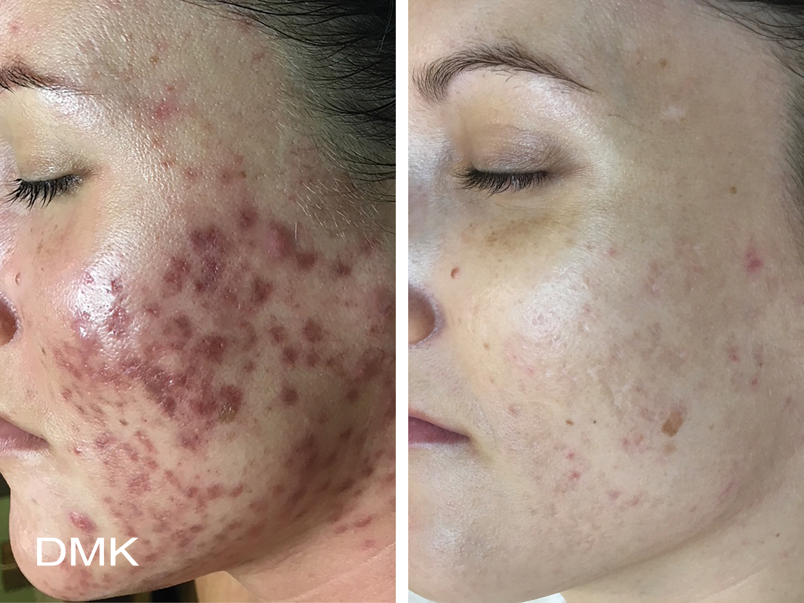 Scarring DMK Results DMKCustomer